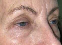 Combination Surgeries (eyelid lift and other)