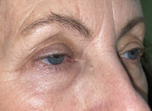 Combination Surgeries (eyelid lift and other)